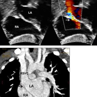 2d echo with cfds|2D echocardiography (upper left image) with CFD .
